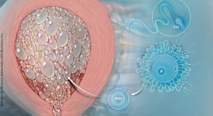 Hydatidiform mole: Recognition and management