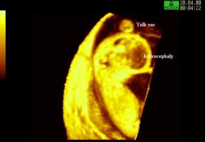 3D Surface Reconstruction Hydrocephalus
