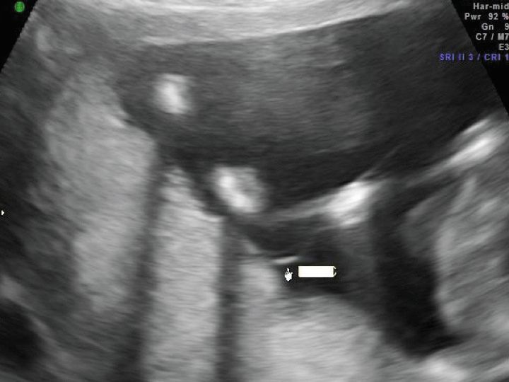 Target Sign Fetus Ultrasound images: Fetal anomalies in multi-fetal gestations