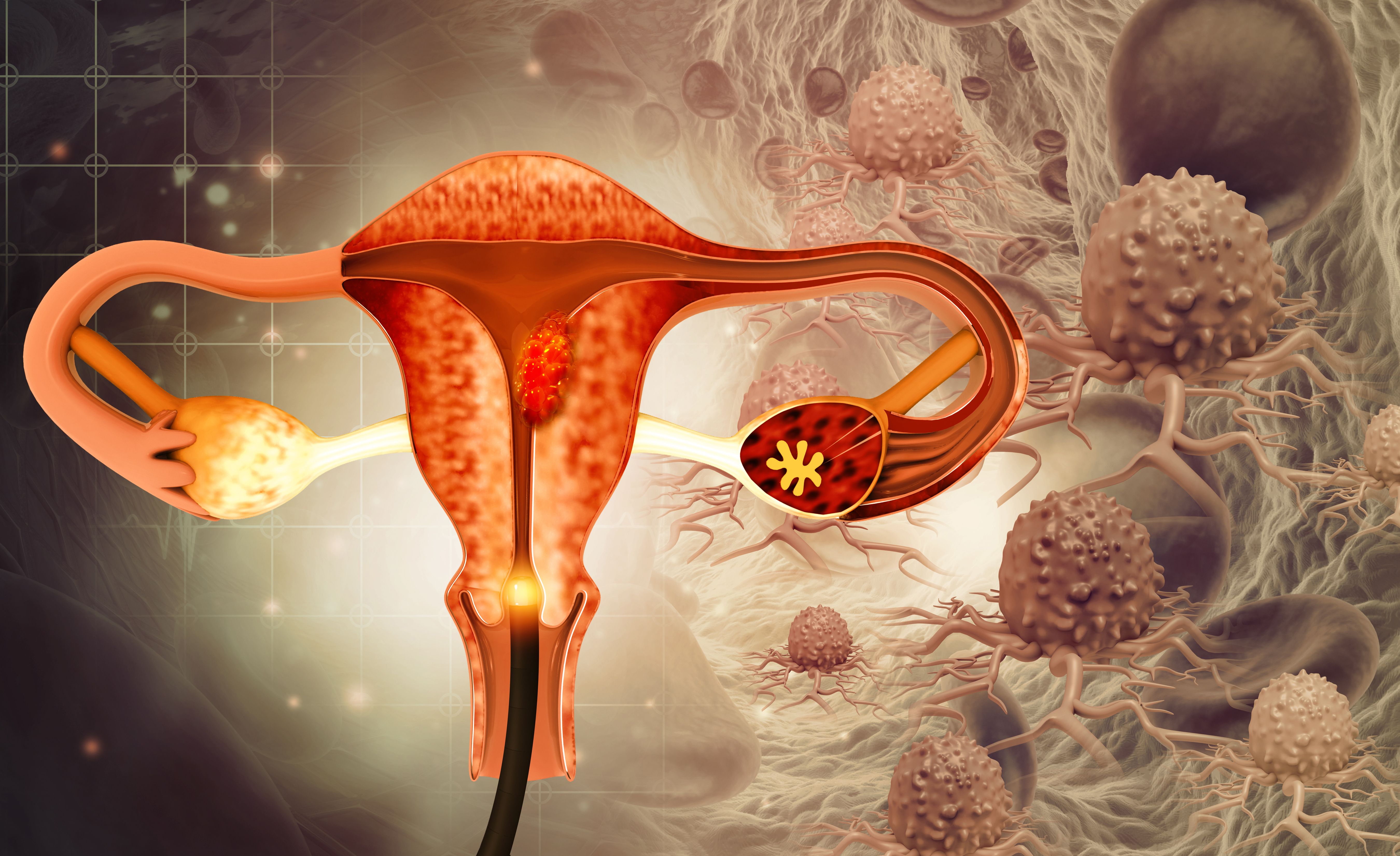 Dieta endometriosis y embarazo