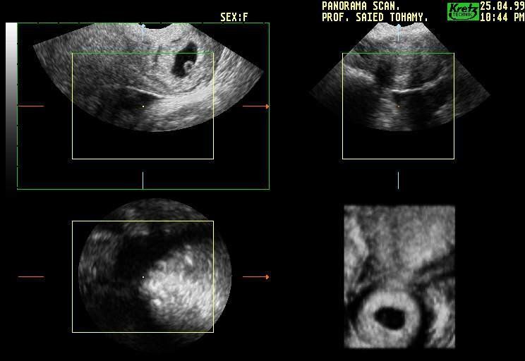 Внематочная Беременность Фото Узи