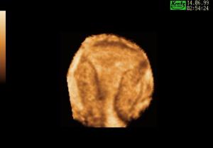 COR Uterus (3D Reconstruction) Normal Endometrium