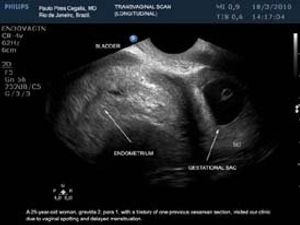 Ectopic Pregnancy Within a Cesarean Delivery Scar