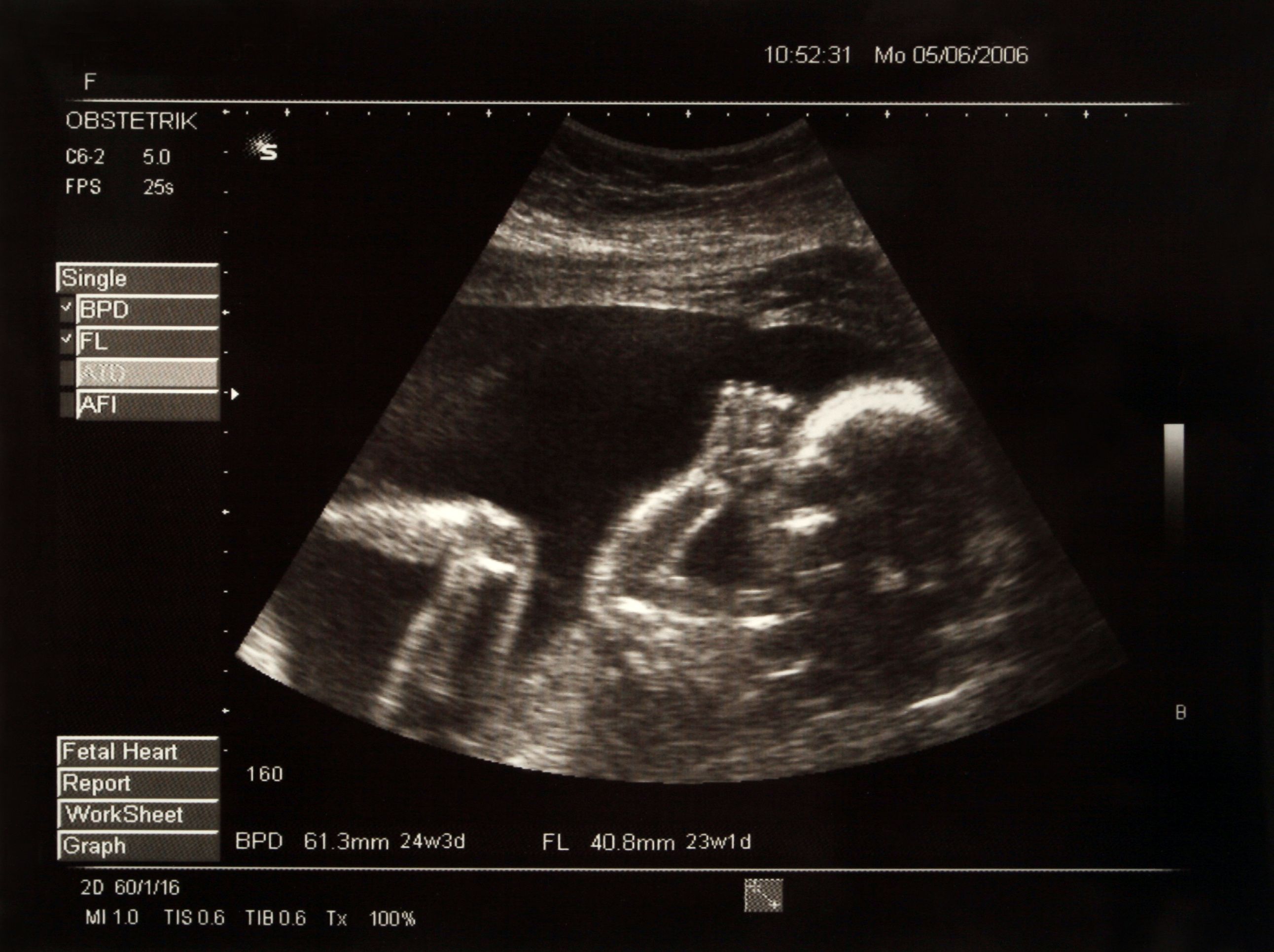Deep dive into fetal ventriculomegaly | Image Credit: © Mikael Damkier - © Mikael Damkier - stock.adobe.com.