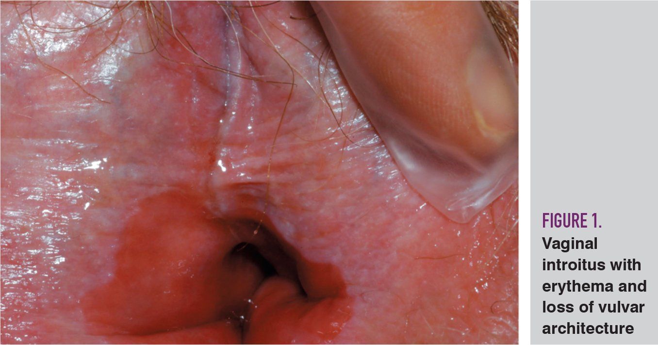 tirzepatide vaginal bleeding Vulvar pain, difficulty swallowing, and bleeding with intercourse