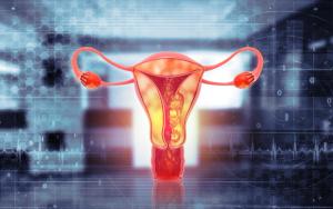 Selinexor maintenance improves PFS in endometrial cancer
