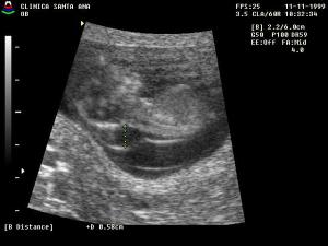LONG Fetus Increased Nuchal Translucency