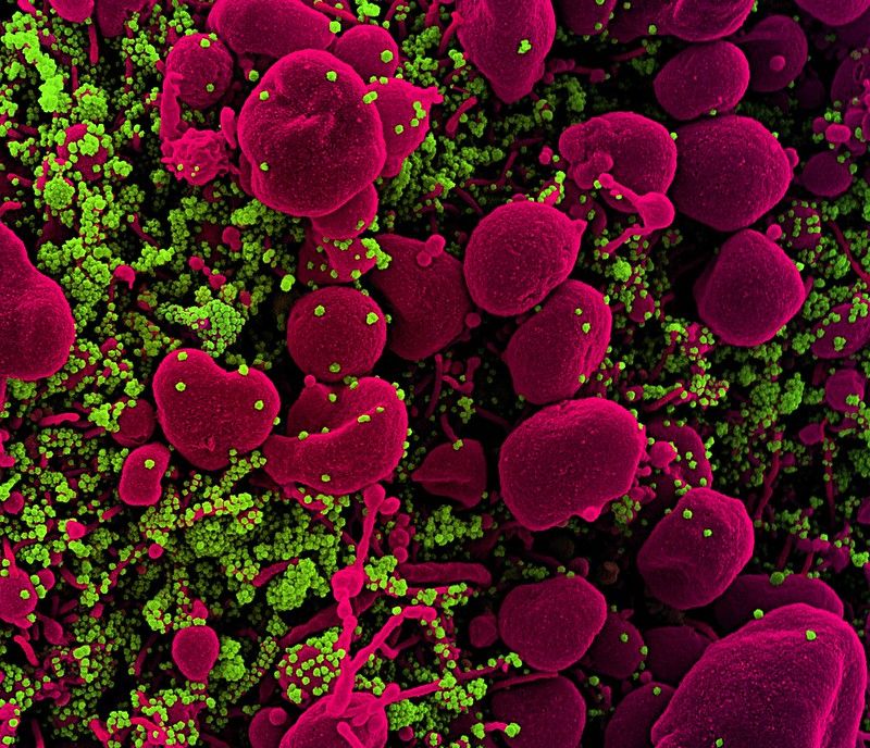 Colorized scanning electron micrograph of an apoptotic cell (pink) heavily infected with SARS-COV-2 virus particles (green), isolated from a patient sample. Image captured at the NIAID Integrated Research Facility (IRF) in Fort Detrick, Maryland.     Credit: National Institute of Allergy and Infectious Diseases/NIH