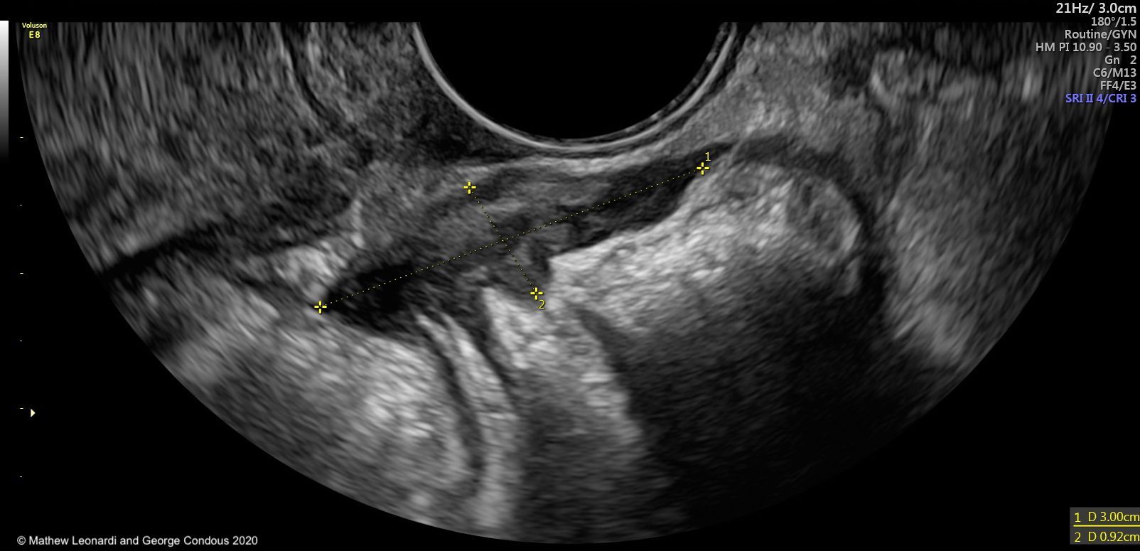 noninvasive-ultrasound-diagnosis-of-endometriosis-contemporary-ob-gyn