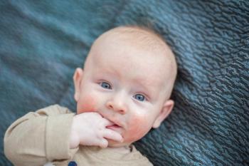 Atopic dermatitis