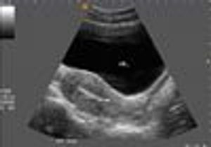IUCD inside endometrial cavity 2D ultrasound (SAG view)