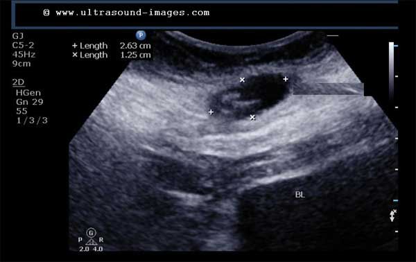 Lcsc Radiography Daily Dx: Post LSCS