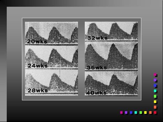 Doppler of the Uterine and Umbilical Arteries: Clinical Significance