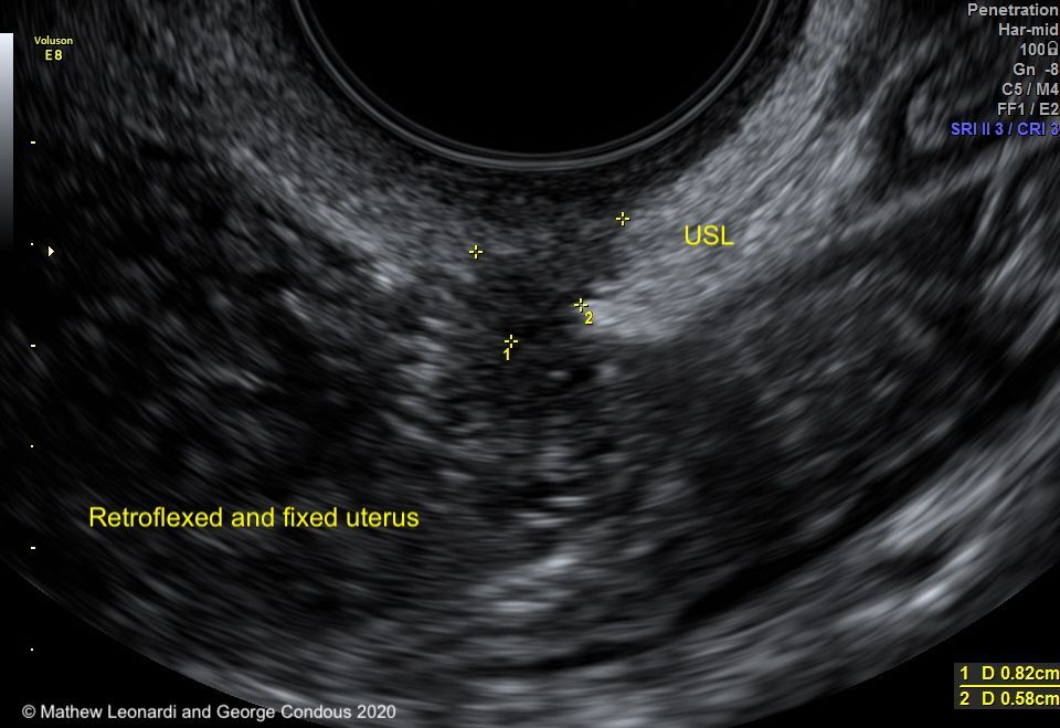 Noninvasive Ultrasound Diagnosis Of Endometriosis Contemporary Obgyn