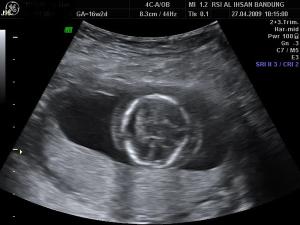 Hydrops fetalis Scalp oedeme