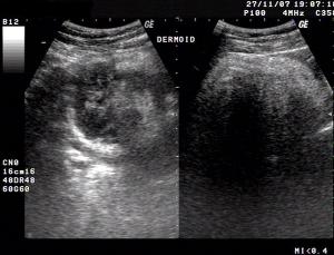 Mixed texture voluminous dermoid cyst, 11.5 cm posterior acoustic shadowing