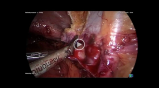 Ovarian Remnant Resection Surgery
