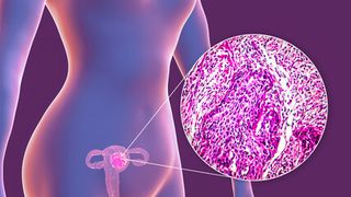 sentinel lymph node mapping