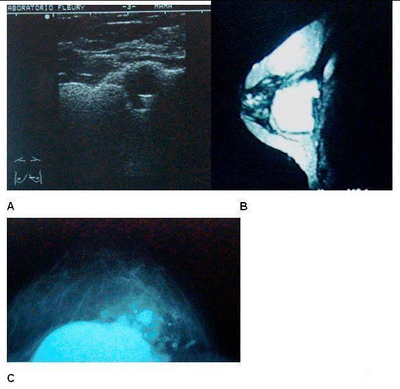 Evaluation of the Rupture of Silicone Breast Implants by Mammography