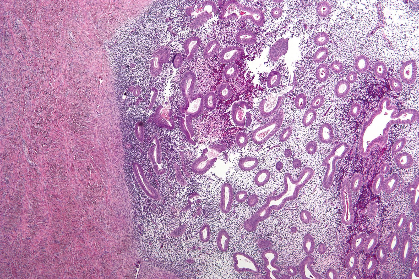 endometriosis of the ovary
