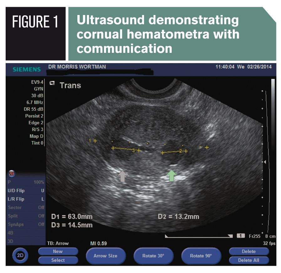 The Migs Approach To Fixing Failed Endometrial Ablation The Migs Approach To Fixing Failed Endometrial Ablation