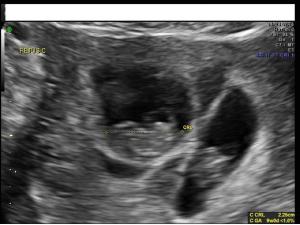 Ultrasound images: Fetal anomalies in multi-fetal gestations