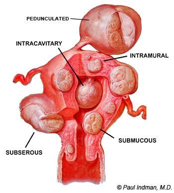 glp 1 fibroids Uterine Fibroids, Infertility, and Pregnancy