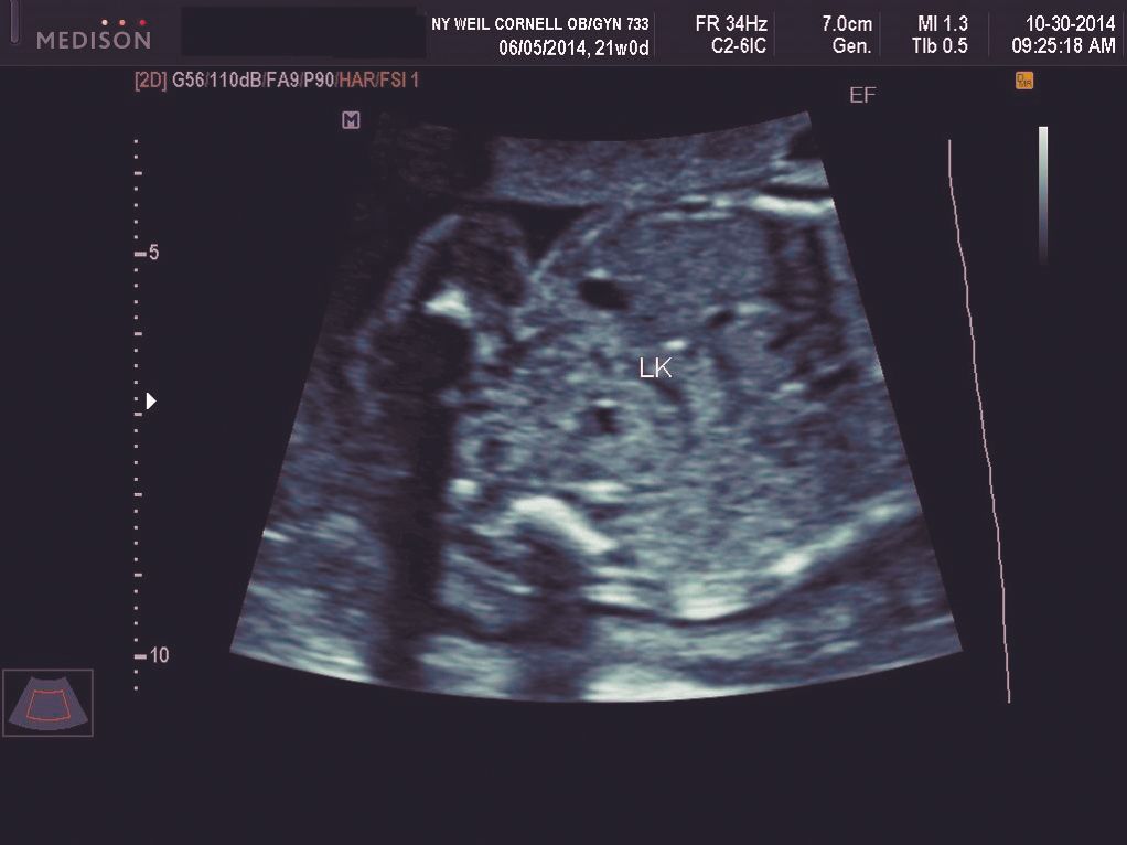 Second trimester pelvic kidney