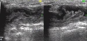 Inguinal nonreducible hernia marked wall edema and surrounding fluid areas