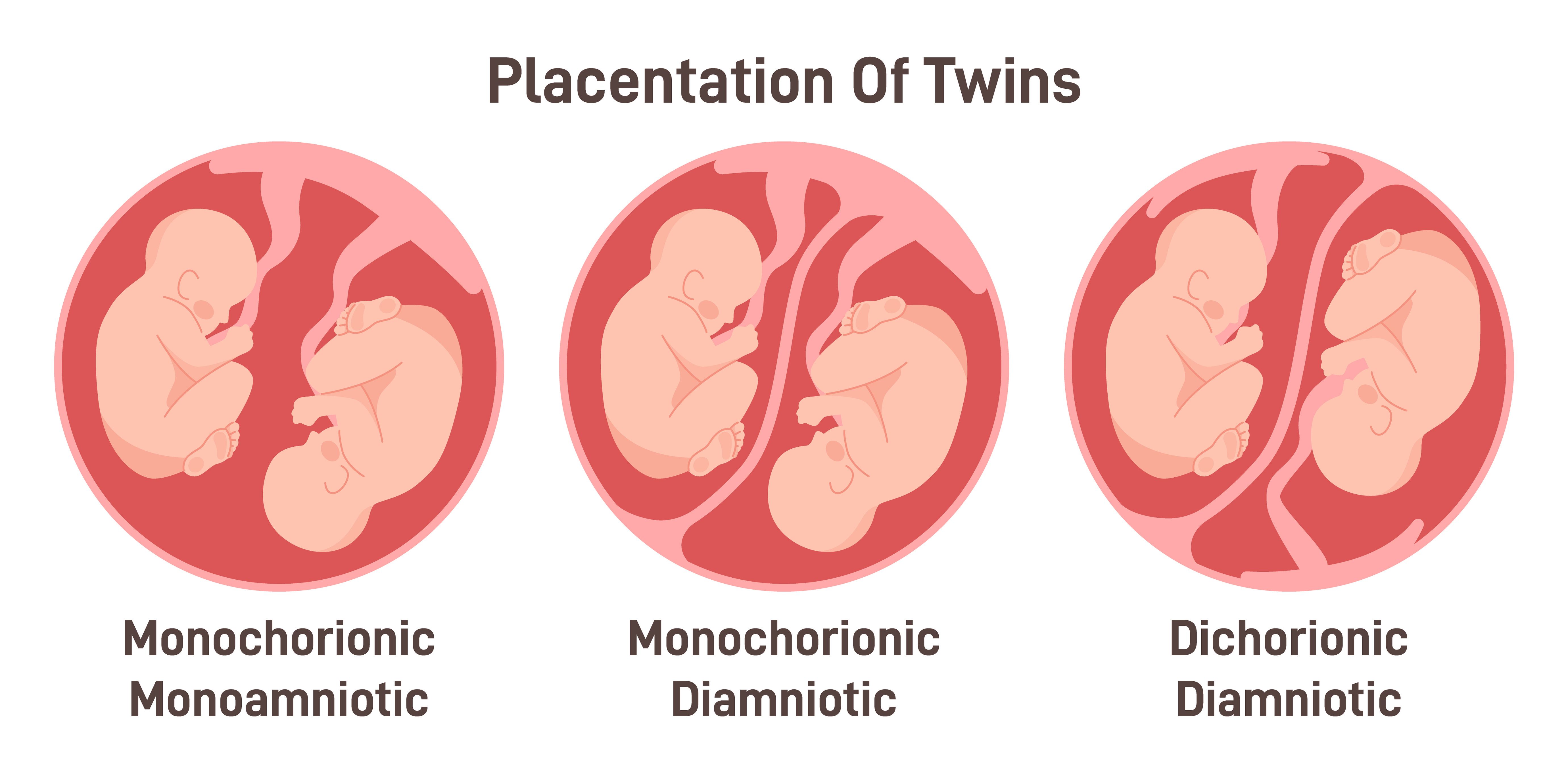 Society for Maternal-Fetal Medicine updates checklists for monochorionic twin pregnancies  | Image Credit: ©  inspiring.team - ©  inspiring.team - stock.adobe.com.