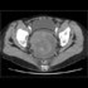 Advancements in Gynecological Oncology