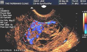 SAG Uterus (Transvaginal) Incomplete Hydatidiform Mole