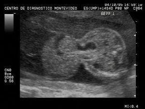 Onphalocele Onphalocele with Liver