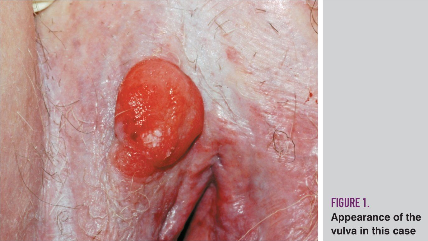 Irregular Vulvar Mass In A Postmenopausal Woman Contemporary Ob Gyn