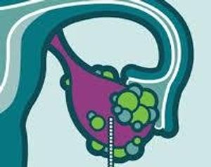 Olaparib Tablet Safe in Relapsed Ovarian Cancer Patients