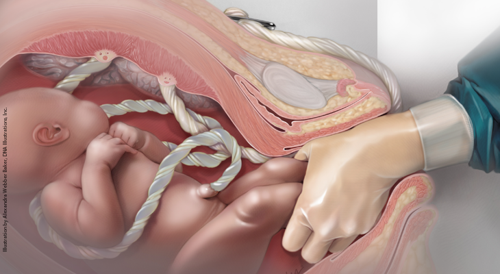 Systems engaged with a vaginal birth Systems engaged with a vaginal birth