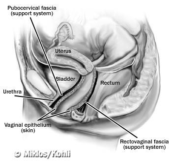 Condiloamele peretelui vaginal anterior, Condiloame pe himen Vagin - Wikipedia