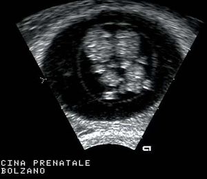 LONG Section of Embryos Monoamniotic Twin Gestation