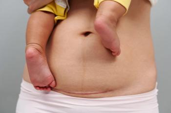 Higher preterm birth risk found following cesarean delivery at full dilation | Image Credit: © geargodz - © geargodz - stock.adobe.com.