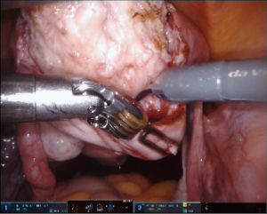 Video: Essure Removal Tips