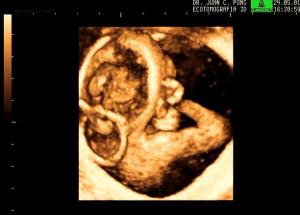 3D Reconstruction Occipital Encephalocele