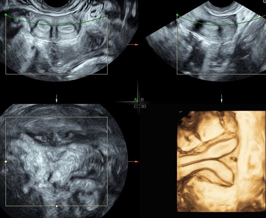 Complete uterine septum