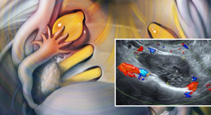Gynecologic Ultrasound