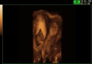 COR Uterus (3D Reconstruction) Early Pregnancy in Didephys Uterus