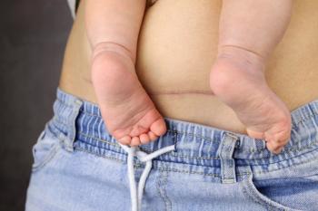Advanced labor cesarean birth raises future preterm birth risk | Image Credit: © Michael - © Michael - stock.adobe.com.