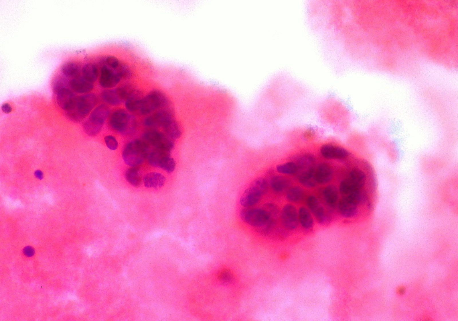 Metastatic Breast Cancer in Pleural Fluid