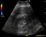 Retained Products of Conception (RPOC)