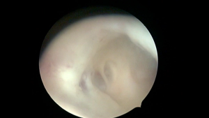 Ashermans Syndrome