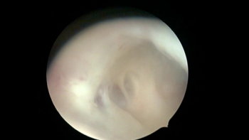 Ashermans Syndrome