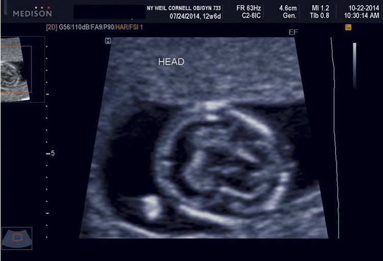 First trimester holoprosencephaly
